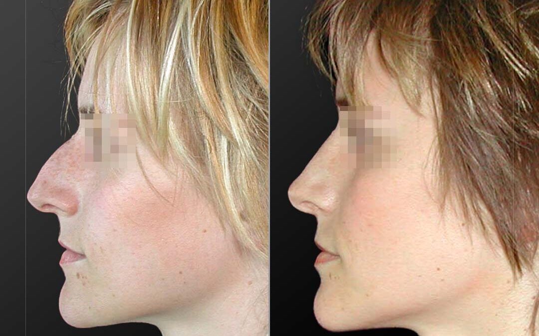 Rhinoplastie