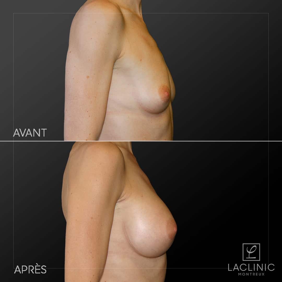 Augmentation mammaire avec implants photo avant-après