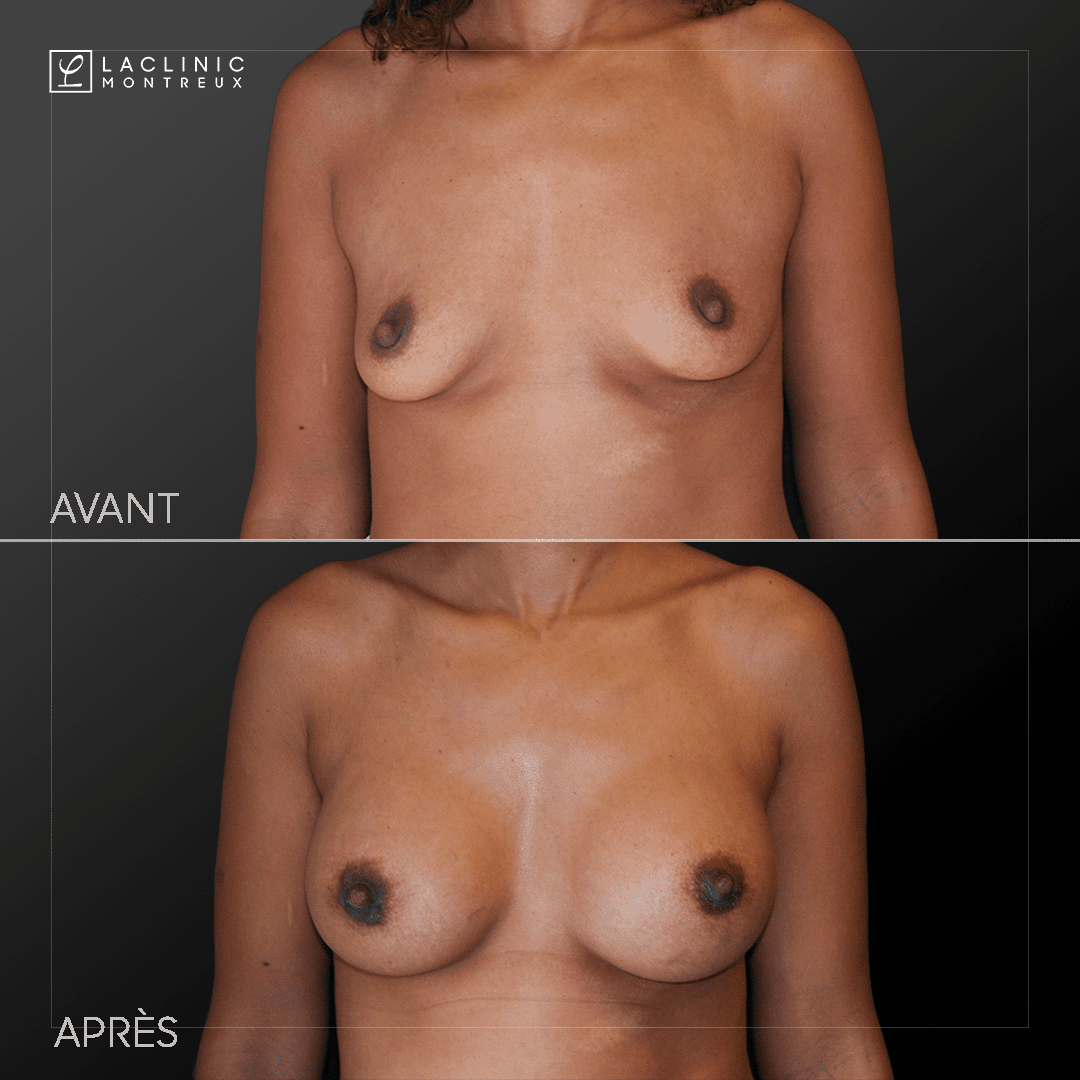 Augmentation mammaire avec implants photo avant-après