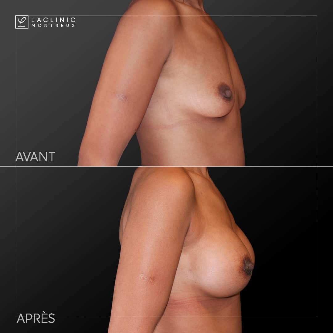 Augmentation mammaire avec implants photo avant-après