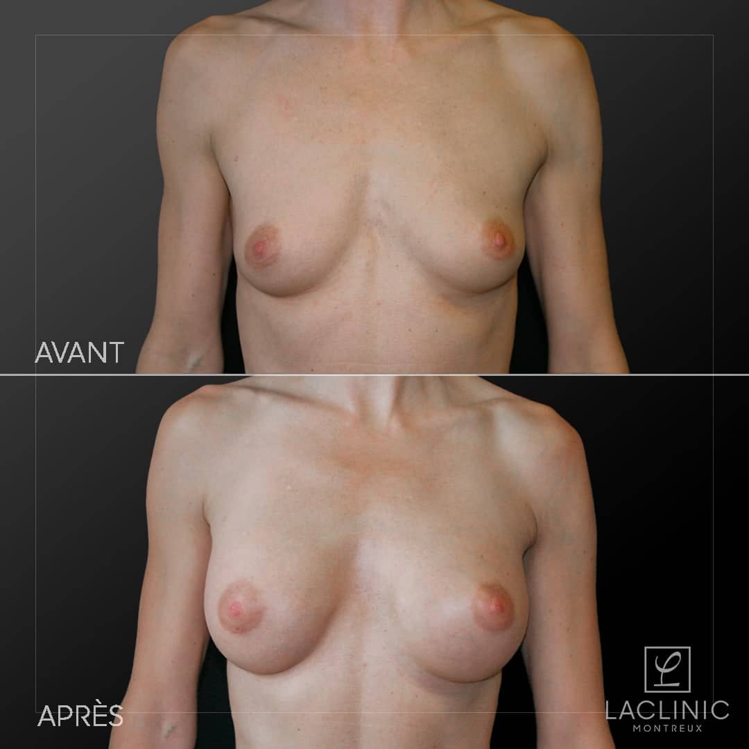 Augmentation mammaire avec implants photo avant-après