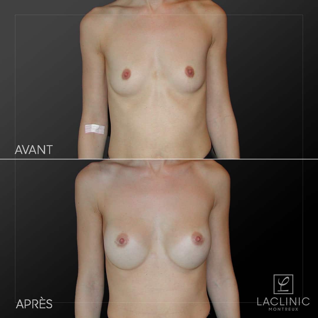 Quiet Beauty : avant-après de l'augmentation mammaire avec implants