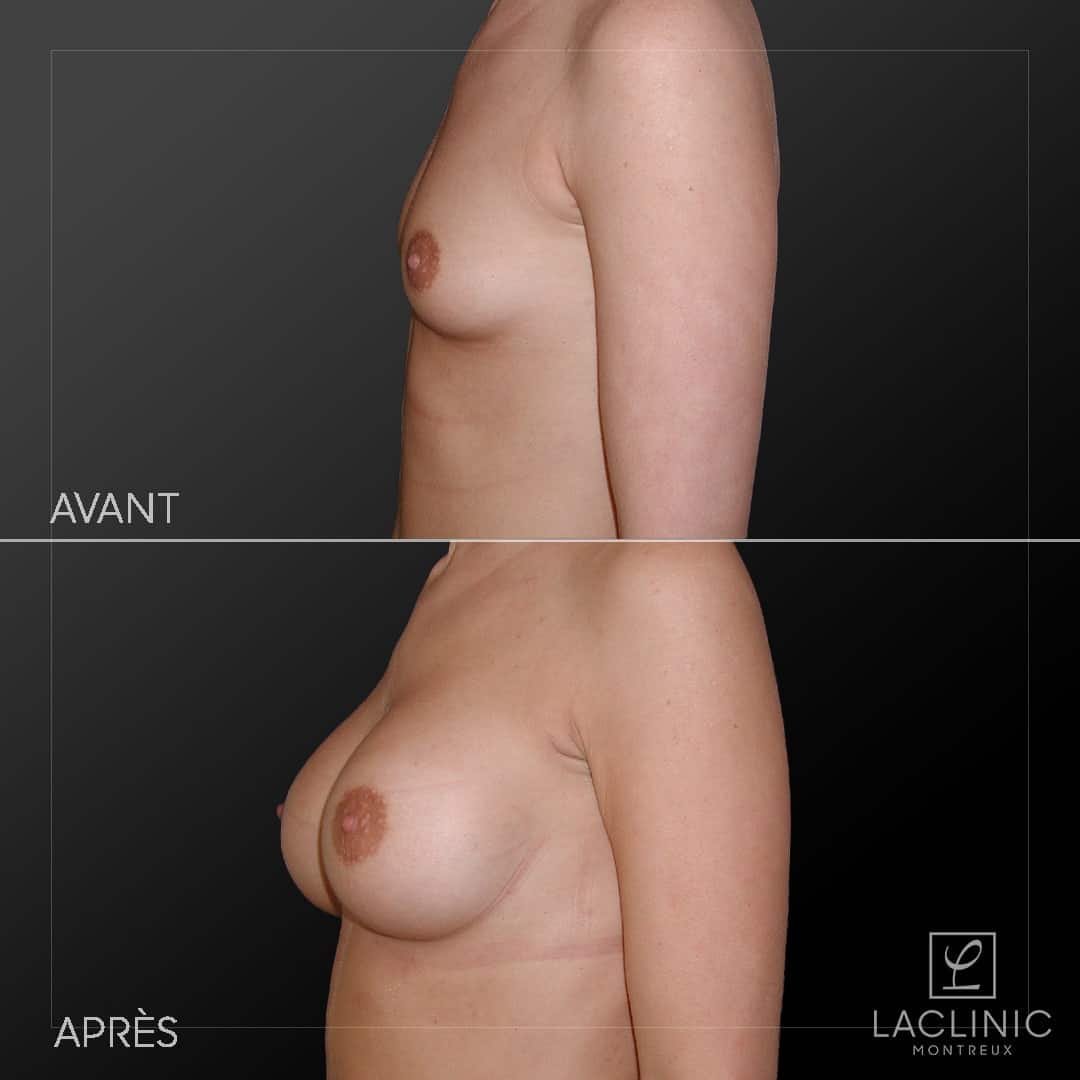 Augmentation mammaire avec implants photo avant-après