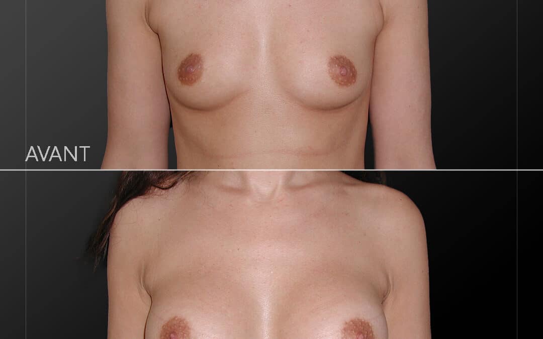 Augmentation mammaire 15
