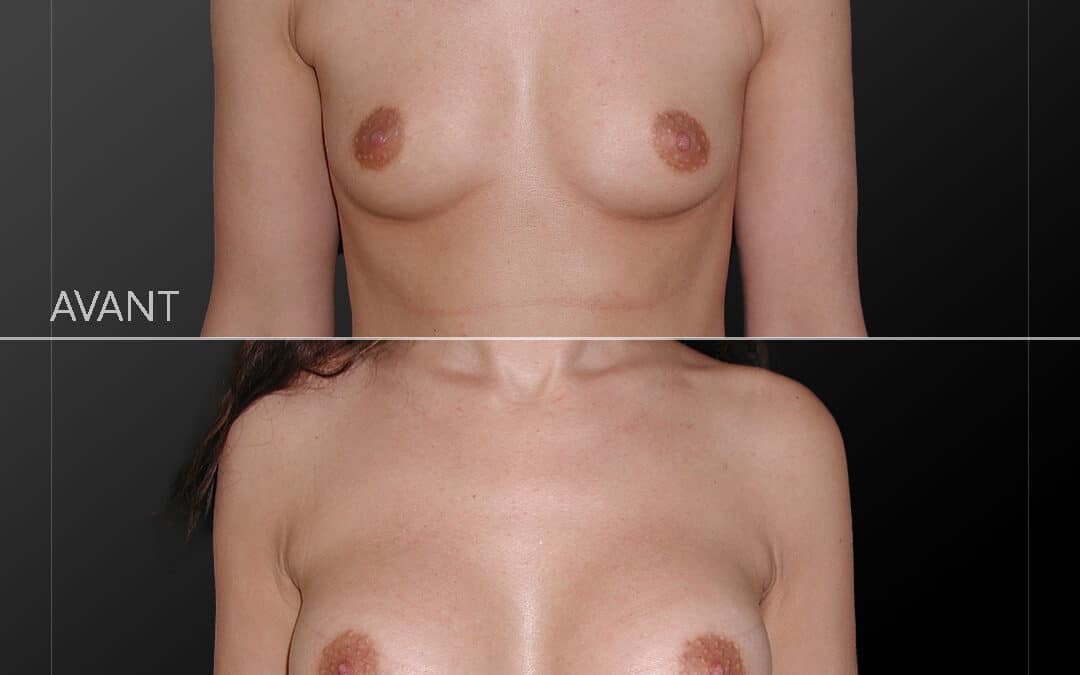 Augmentation mammaire composite