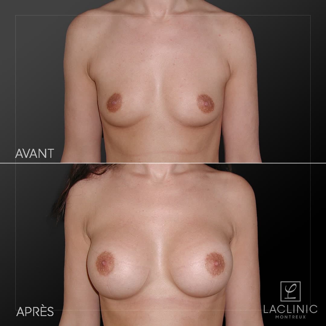 Augmentation mammaire avec implants photo avant-après