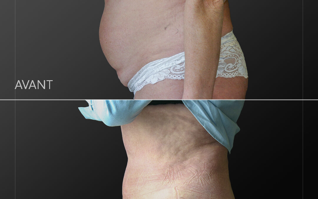 Abdominoplastie