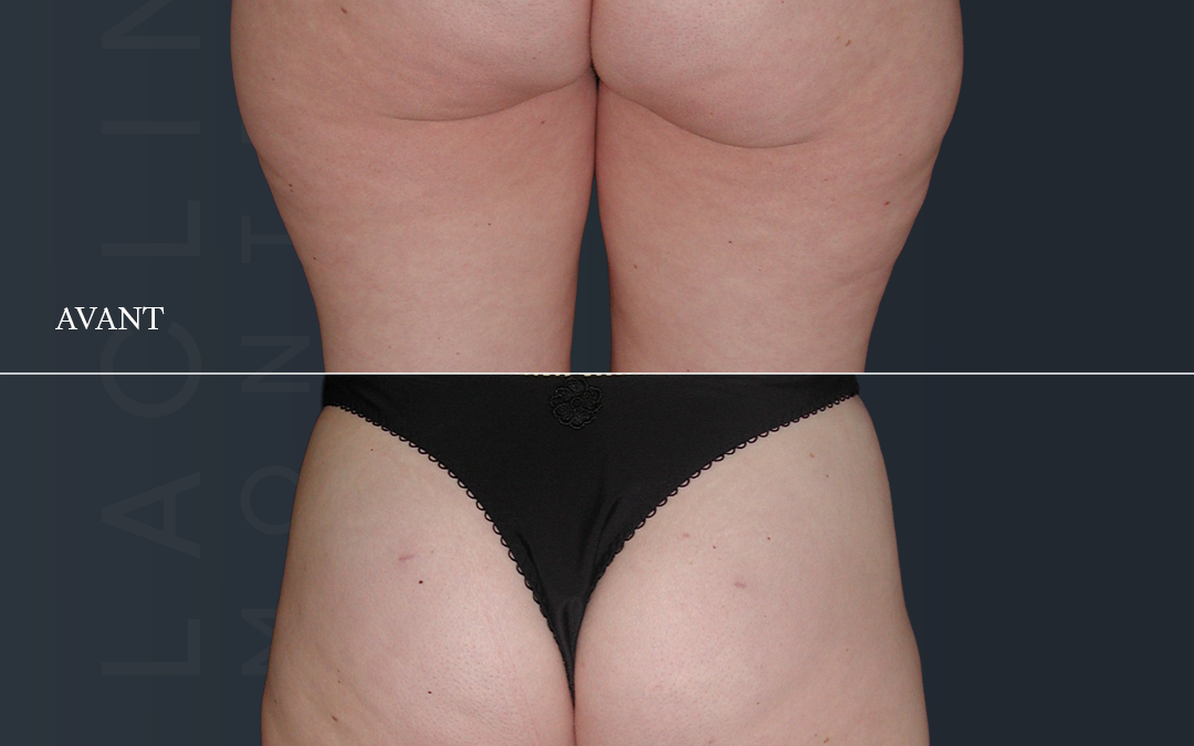 Liposuccion des fesses