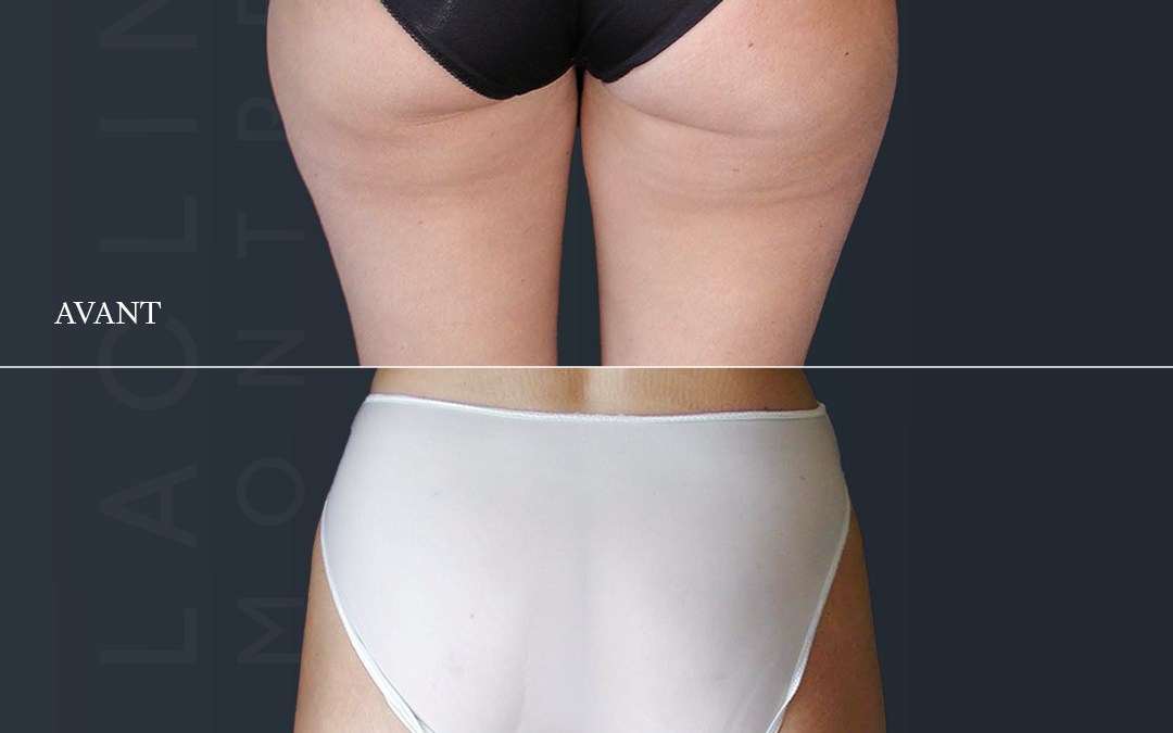 Liposuccion des fesses