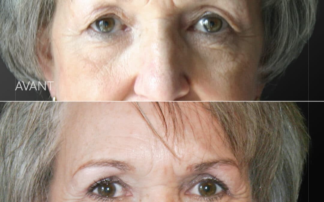 Blépharoplastie