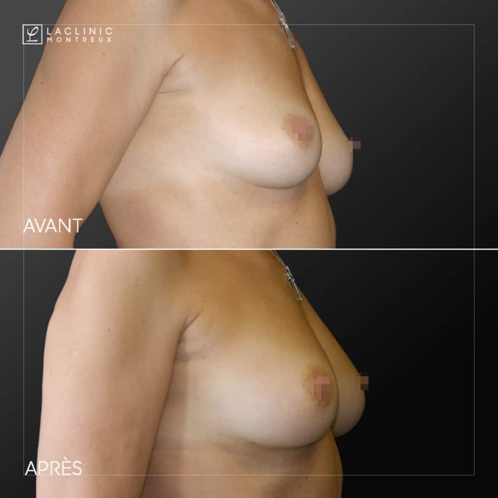 Lipofilling des seins, avant-après