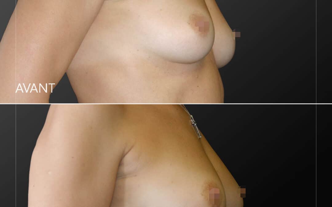 Lipofilling seins