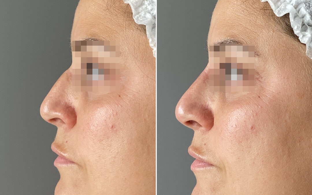 Filler acide hyaluronique nez