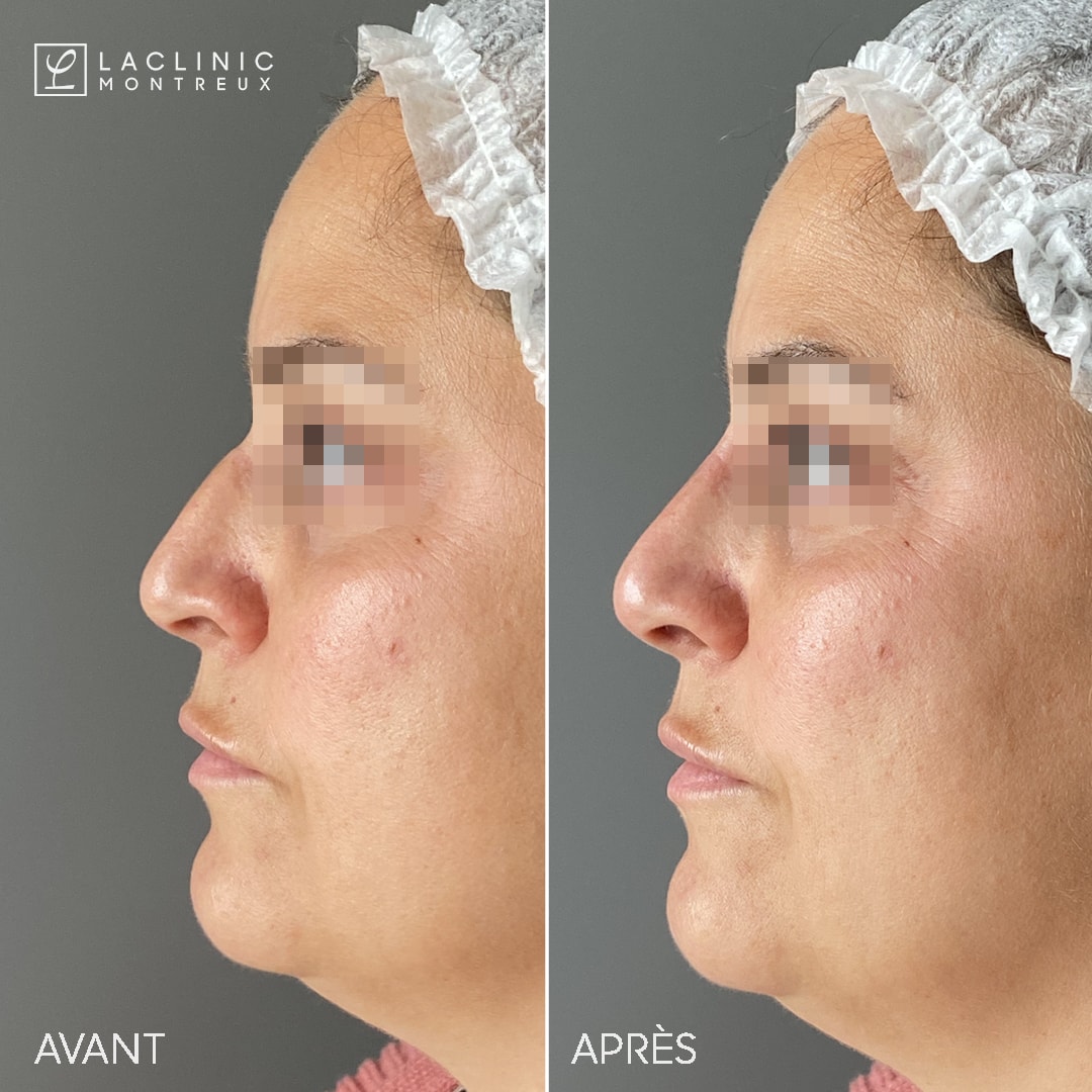 rhinoplastie médicale injection d'acide hyaluronique