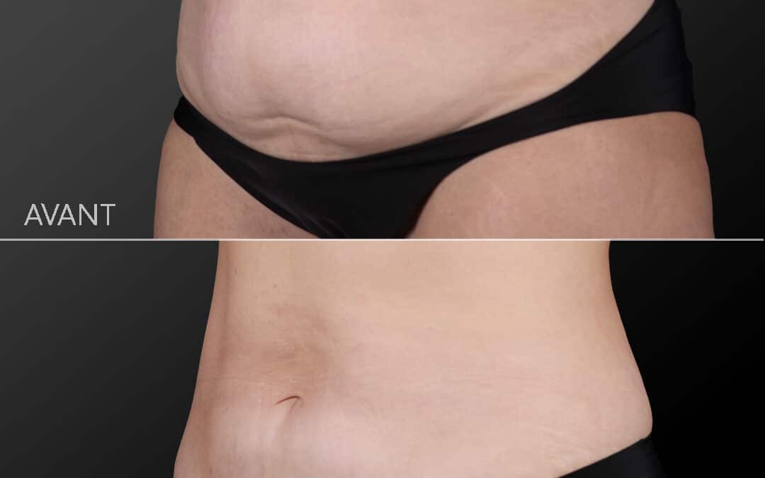 Cryolipolyse Coolsculpting