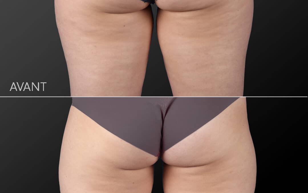 Cryolipolyse Coolsculpting