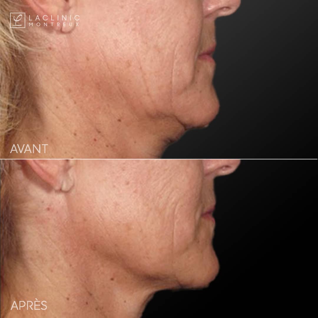Ultherapy avant-apres