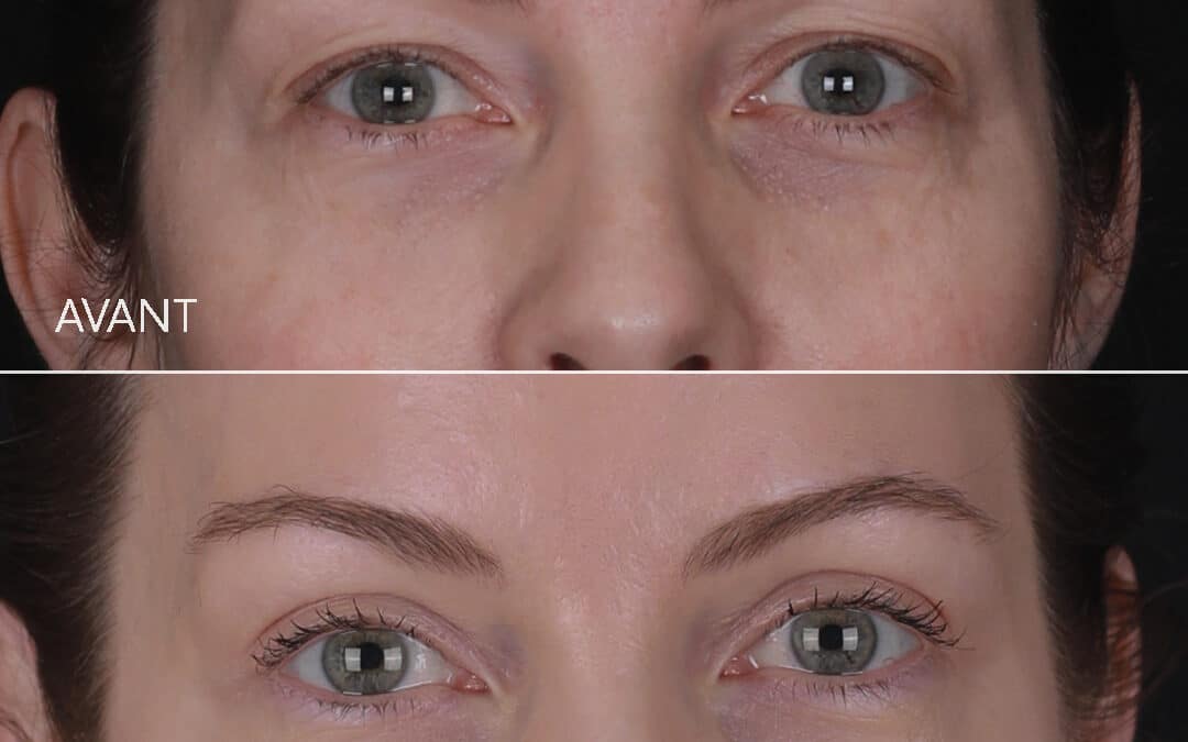 Blépharoplastie