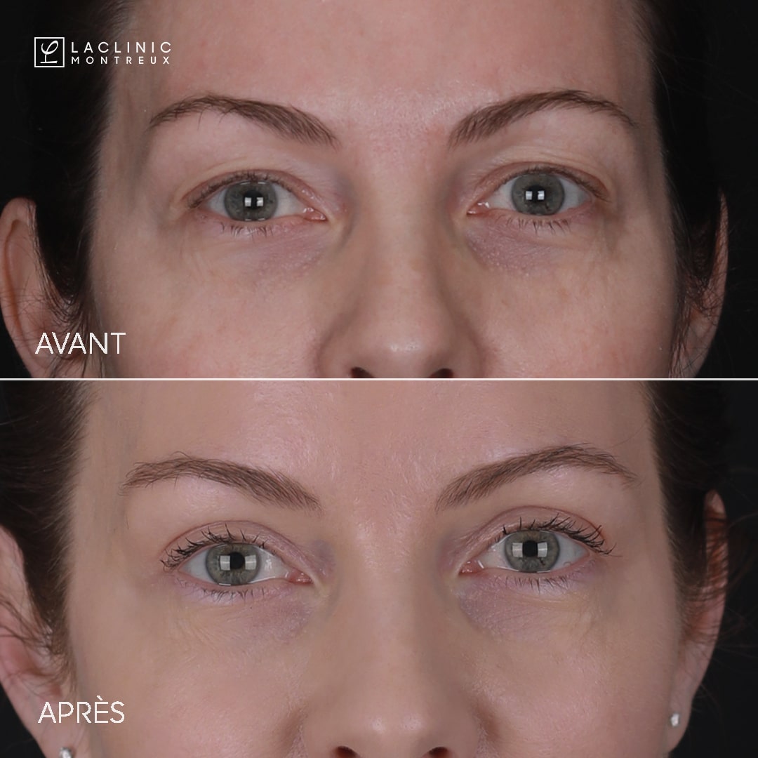 Blépharoplastie supérieure - Dr Brilmaker