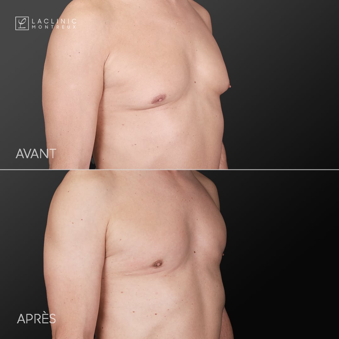 Gynécomastie - correction des seins chez l'homme