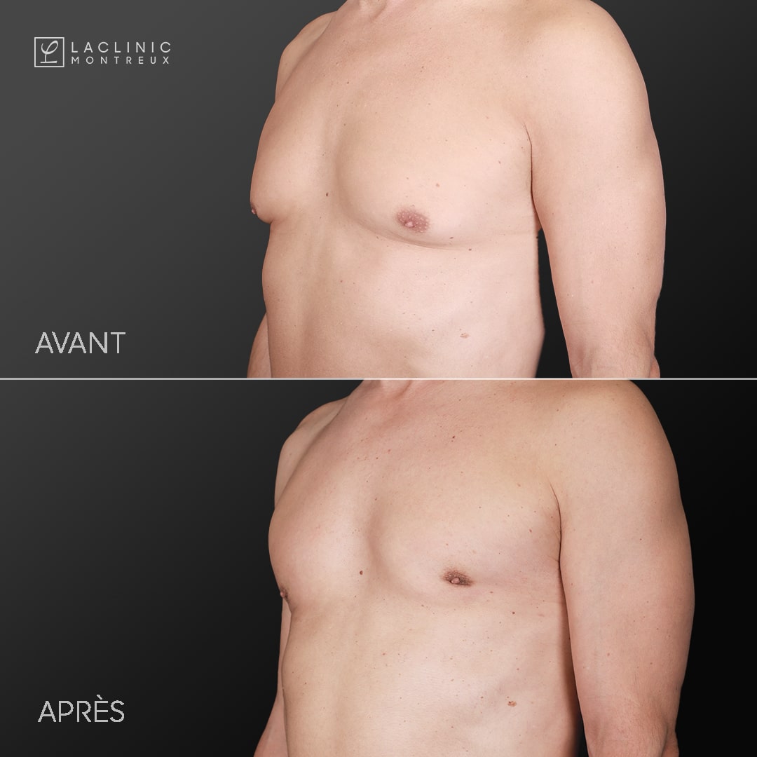 Gynécomastie - correction des seins chez l'homme