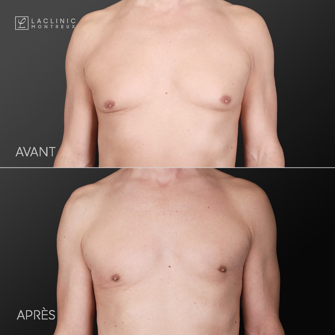 Gynécomastie - correction des seins chez l'homme