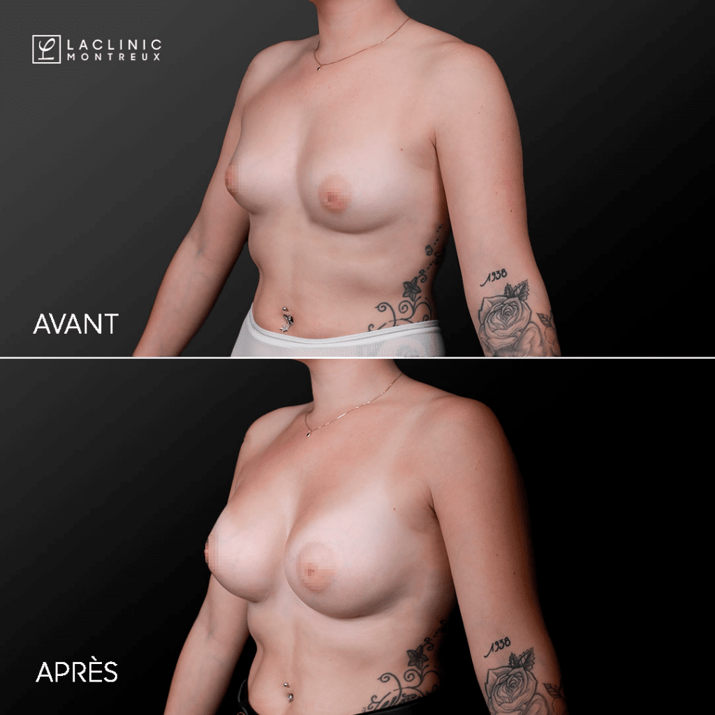 Before breast augmentation