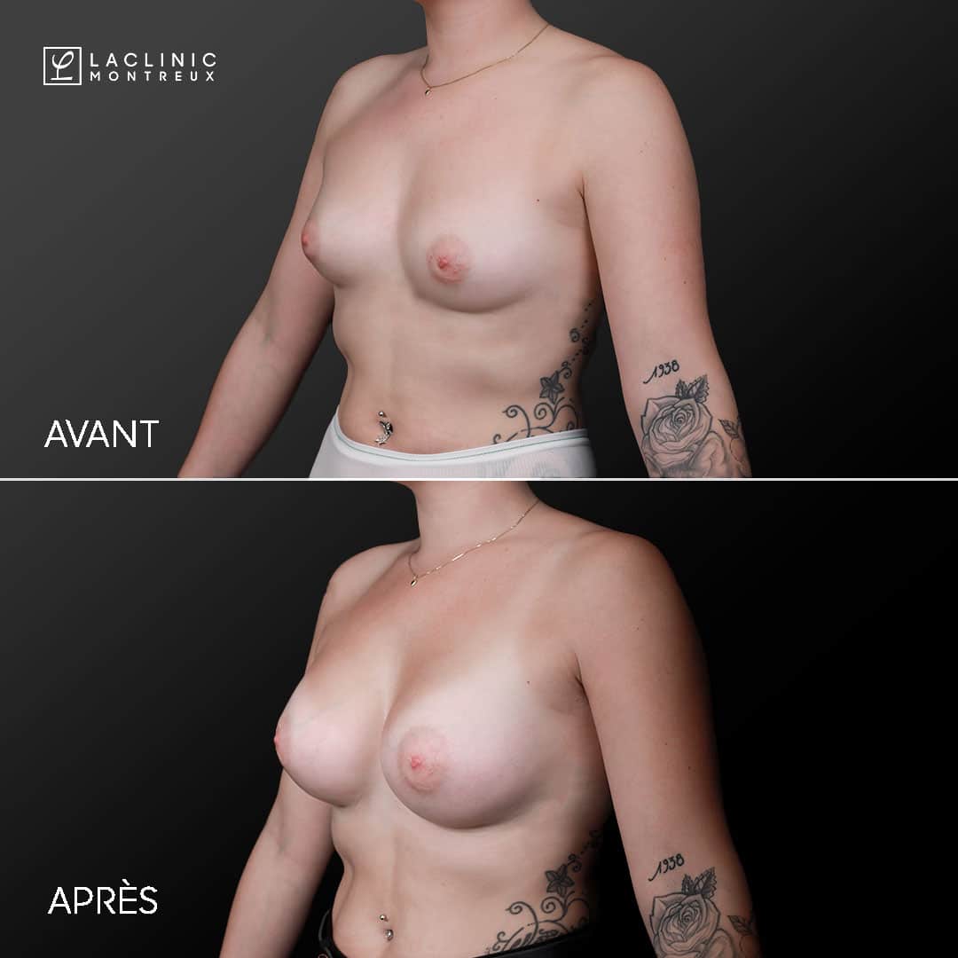 Augmentation mammaire prothétique (285cc) par le Dr Brilmaker