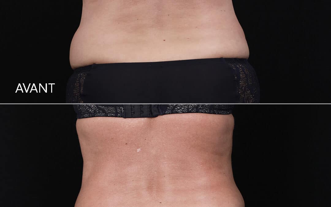 Cryolipolyse Coolsculpting