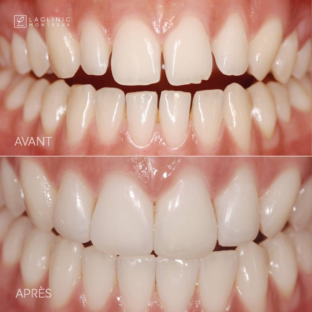 Smile-makeover-before-after