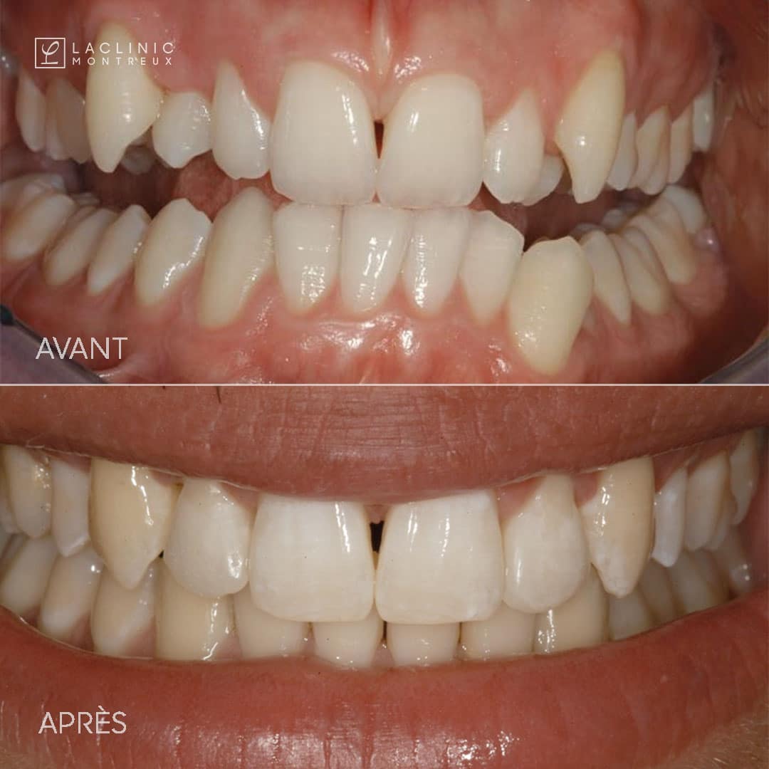 Invisalign avant apres