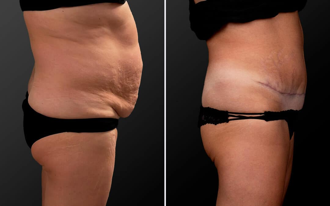 Abdominoplastie