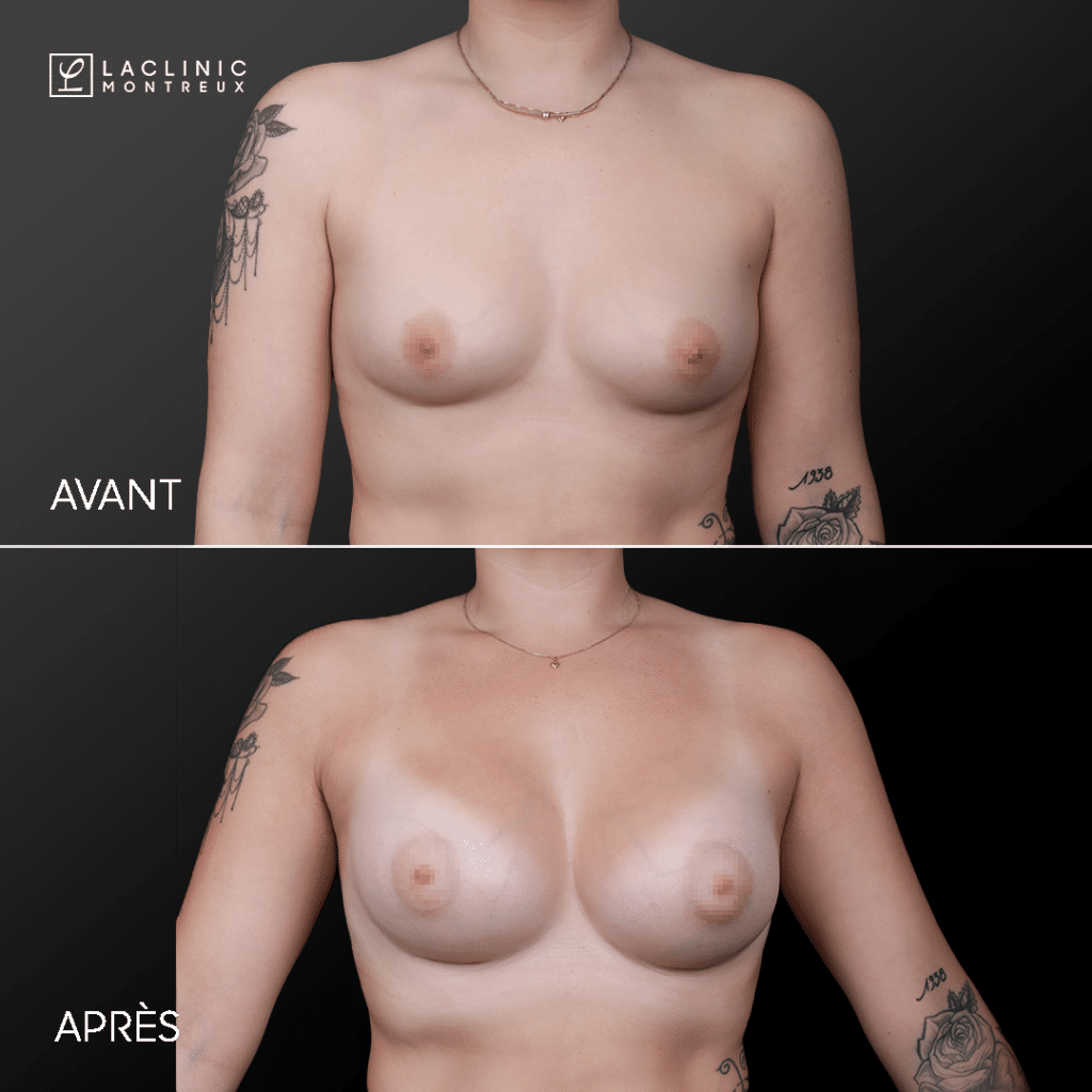 Before after breast implants