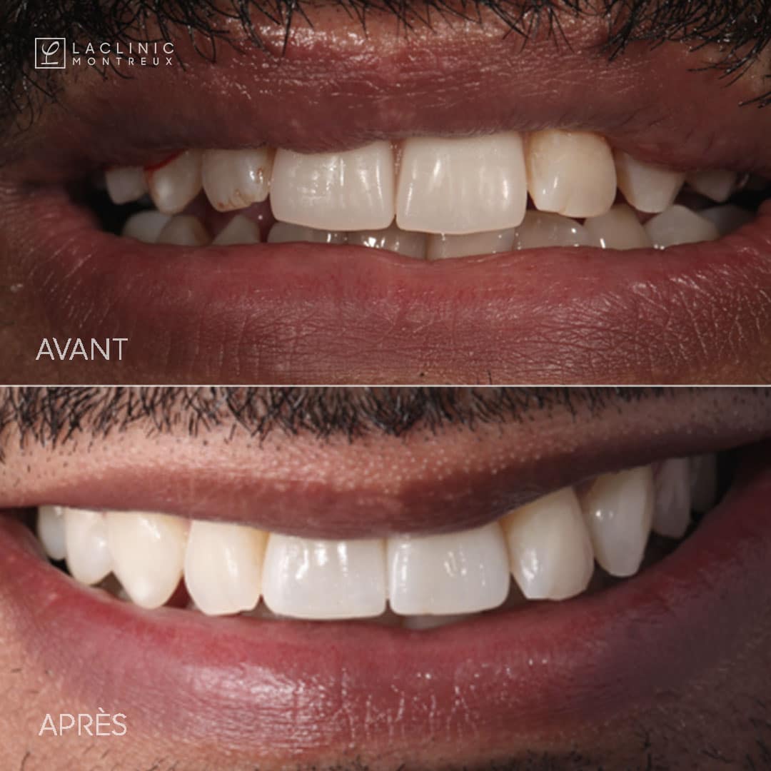 implants dentaires avant-après