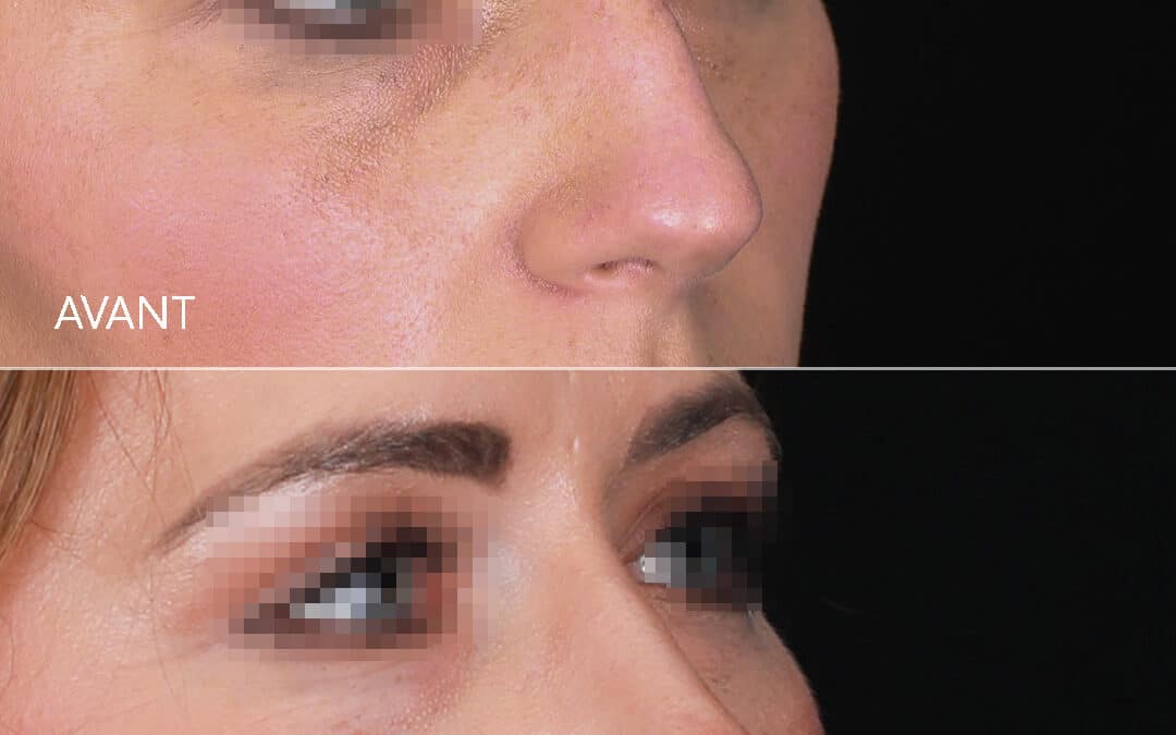 Rhinoplastie
