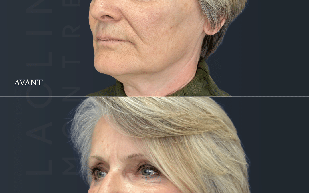 Lifting visage