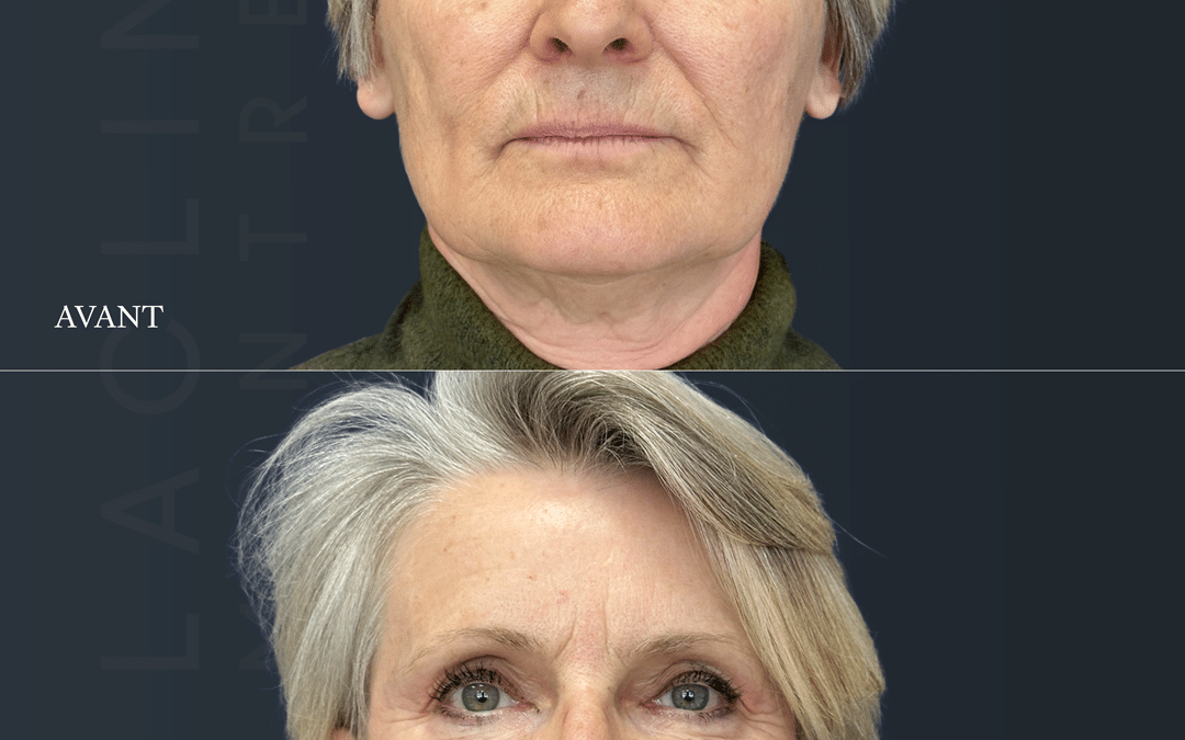 Lifting visage