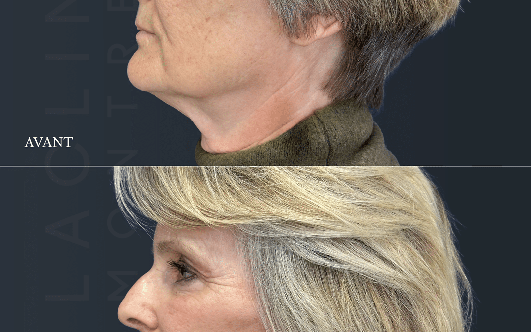 Lifting visage
