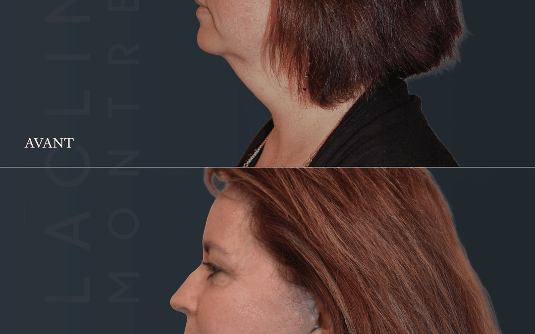 Lifting visage