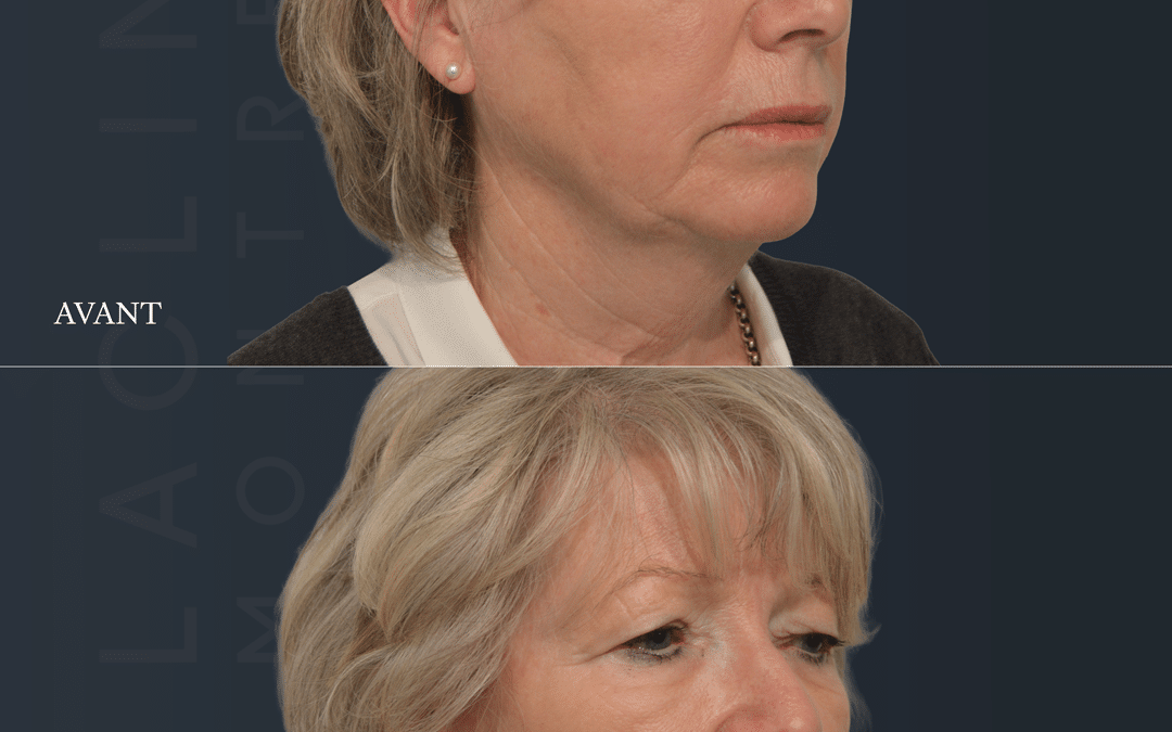 Lifting visage