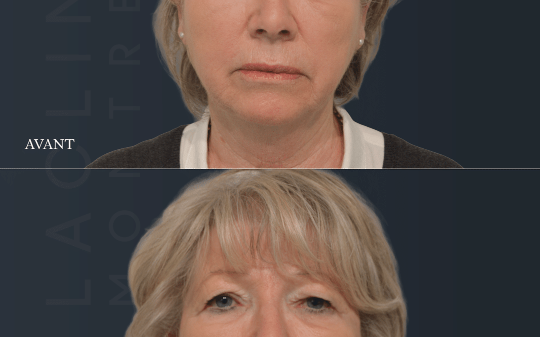 Lifting visage