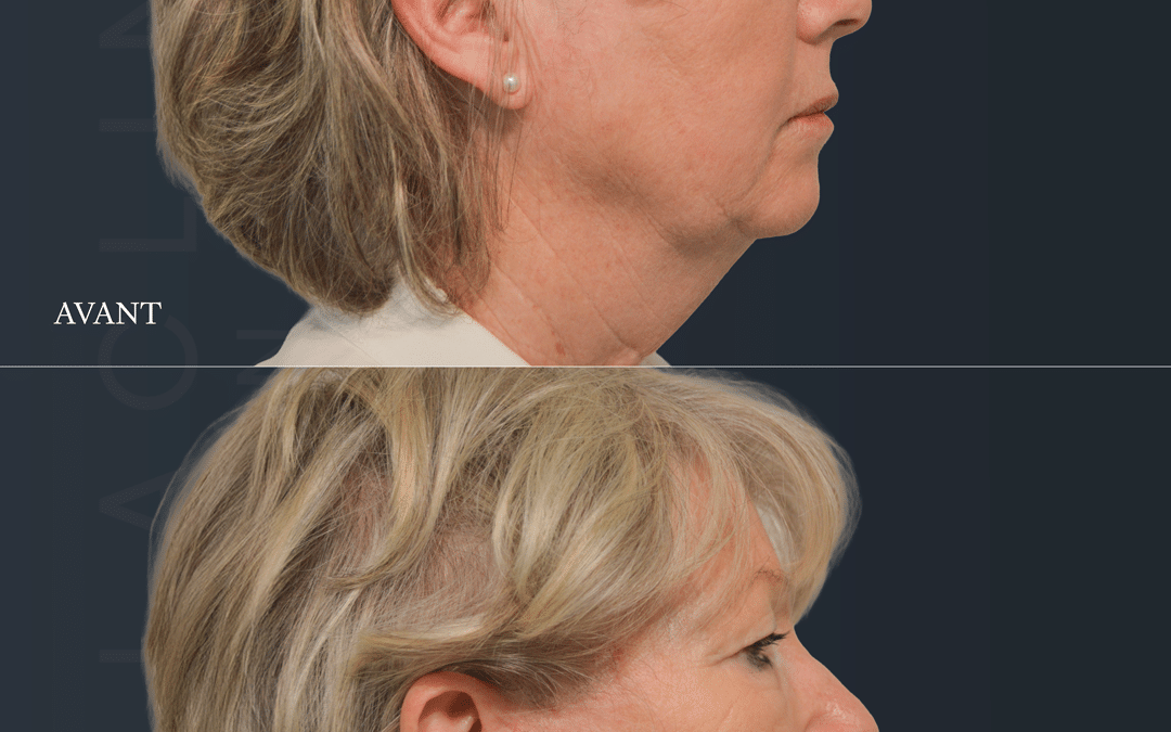 Lifting visage