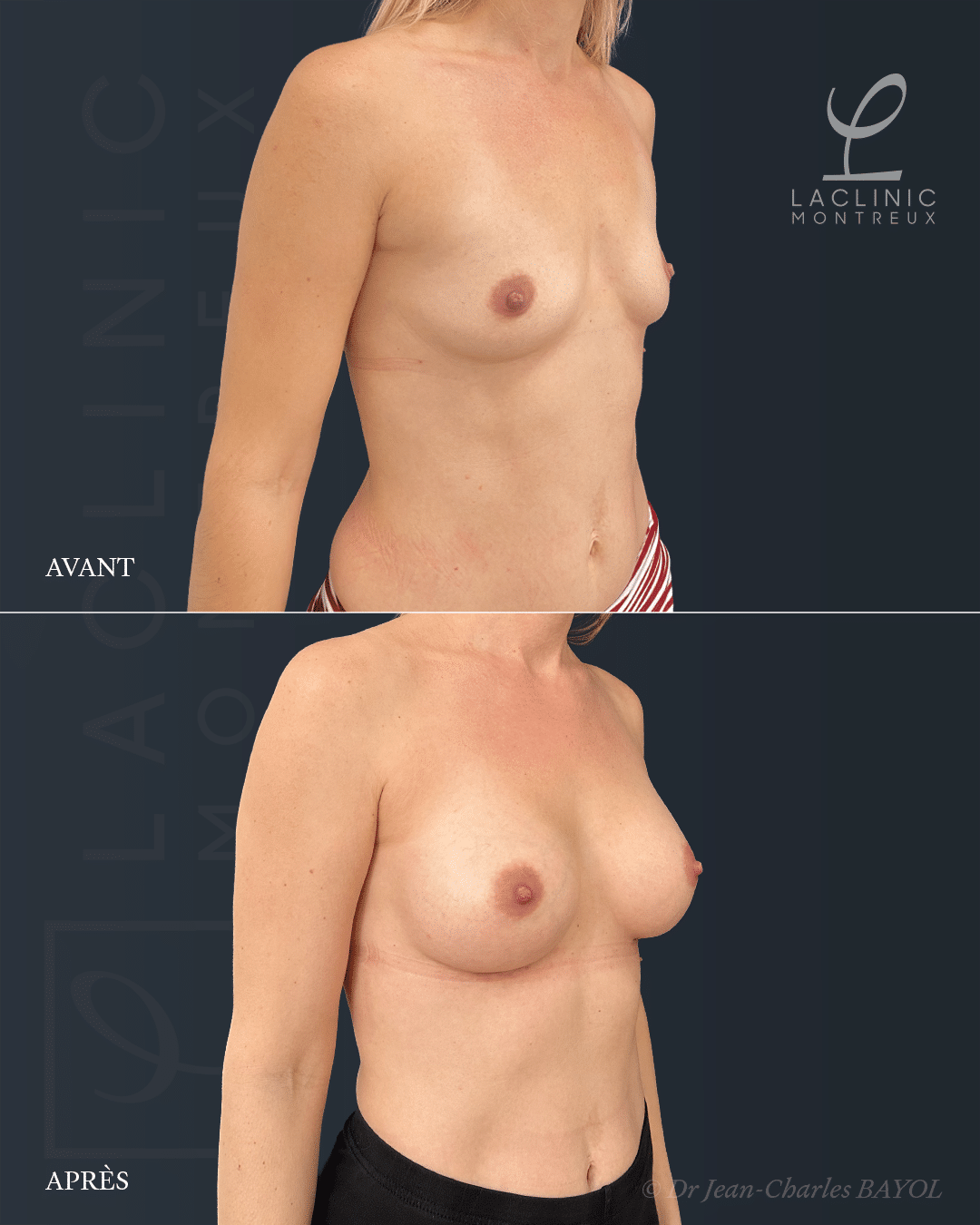 Augmentation mammaire chirurgie des seins avant-après