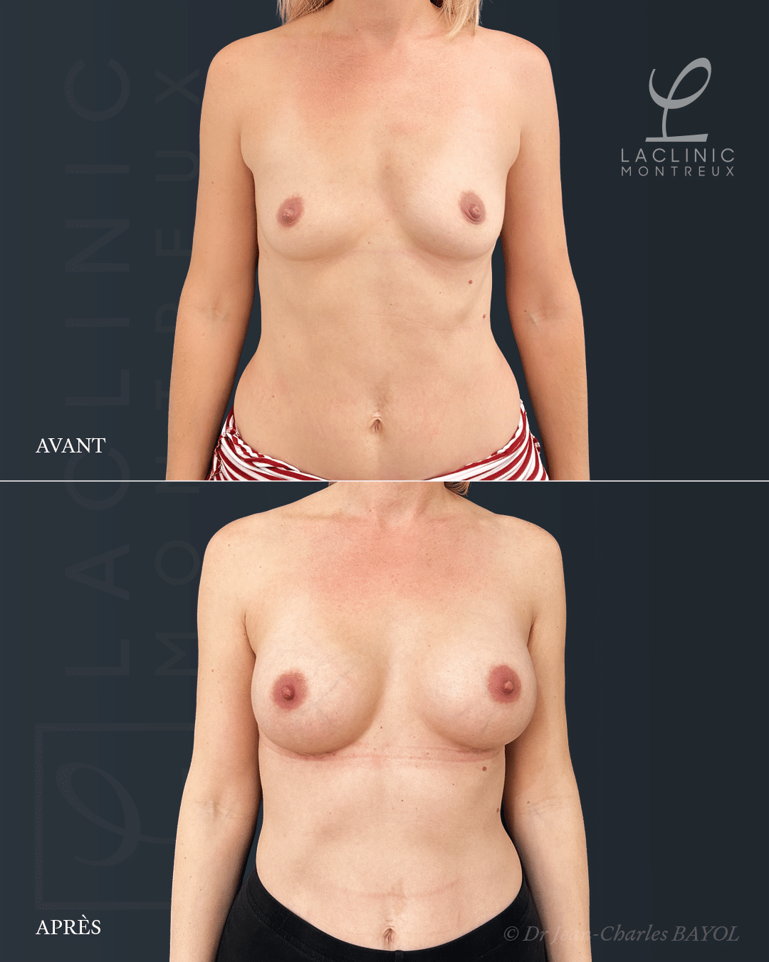 Augmentation mammaire chirurgie des seins avant-après