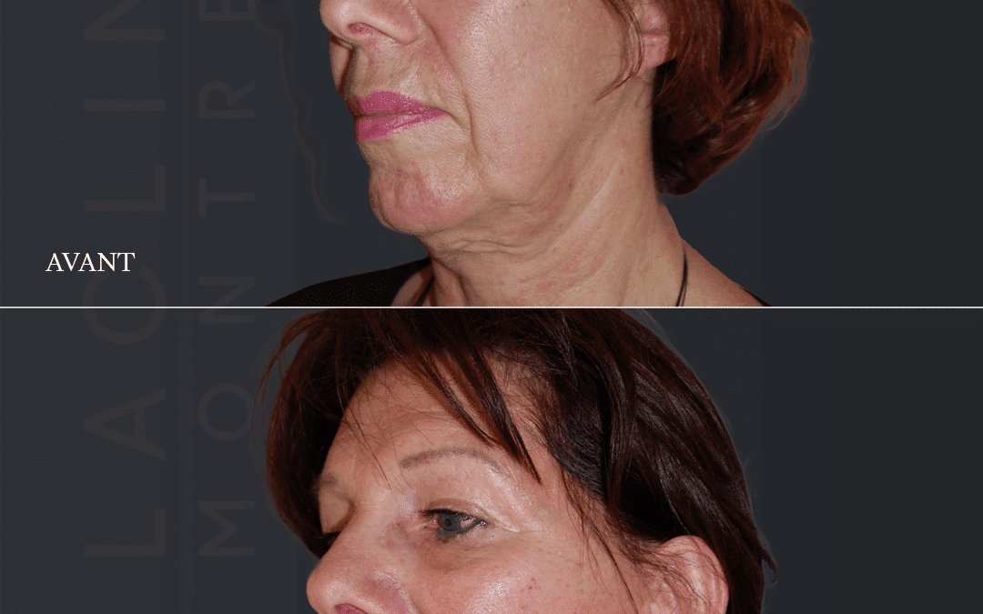 Lifting visage