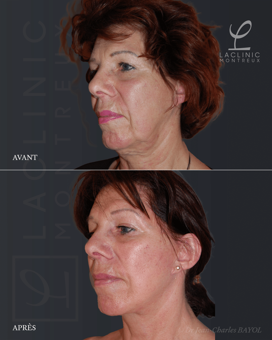 Deep plane facelifting avant-après