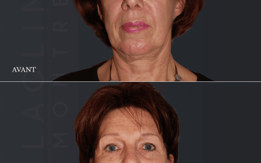 Lifting visage