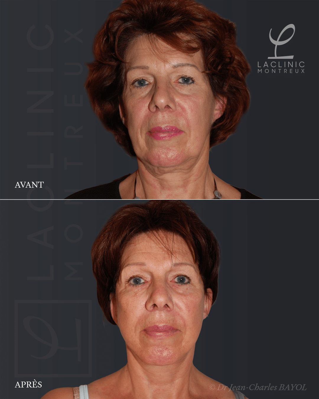 Deep plane facelifting avant-après