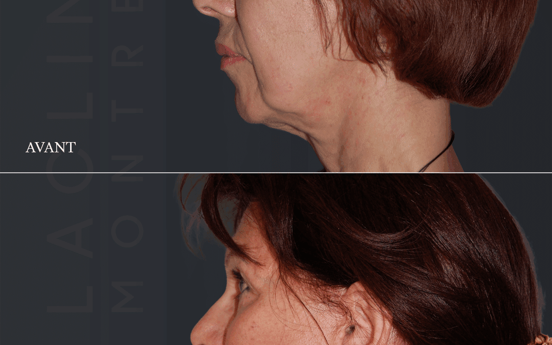 Lifting visage