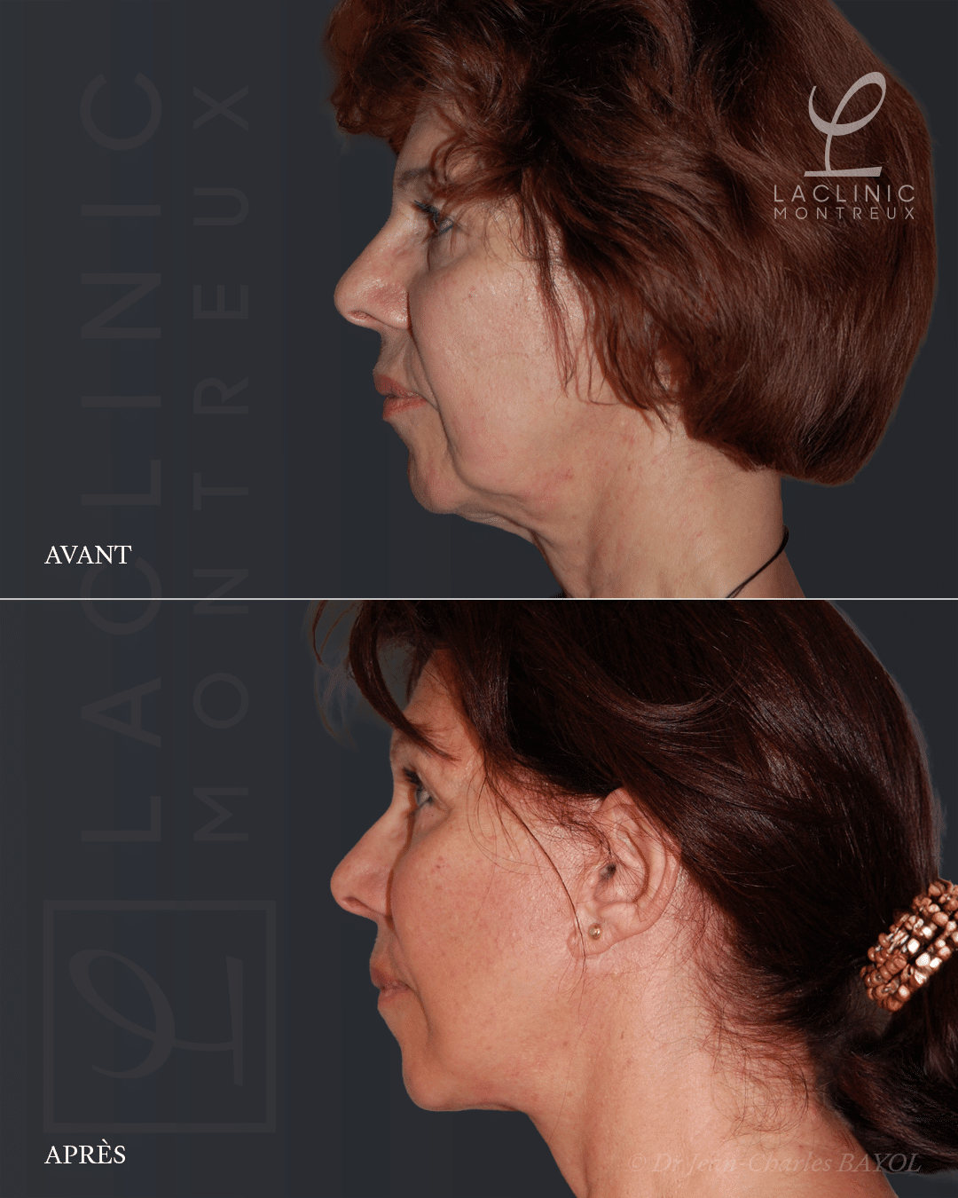 Deep plane facelifting avant-après